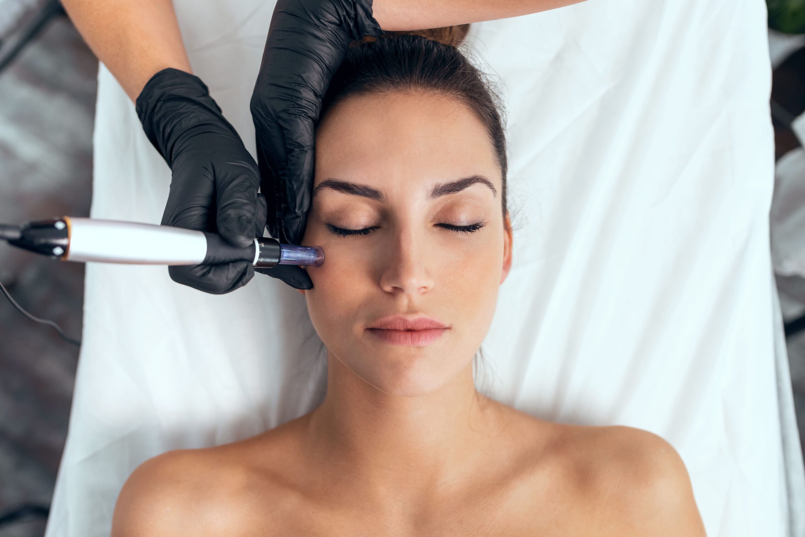 foto-microneedling-láserclinic-nerja